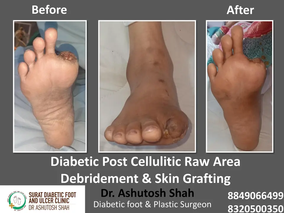 Diabetic Cellulitis and Coverage.pptx-23.webp